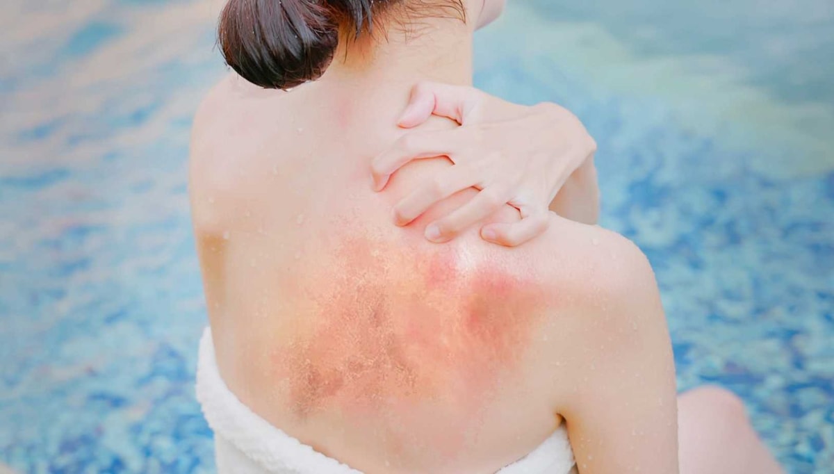 Ces 5 astuces naturelles vous protégeront des brûlures du soleil d'automne