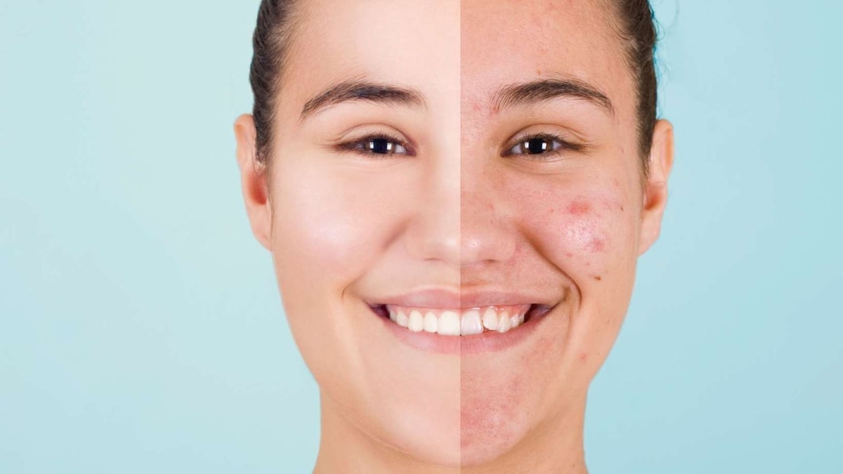 Boutons, rougeurs, cicatrices... Ces 4 huiles essentielles stoppent l'acné sévère