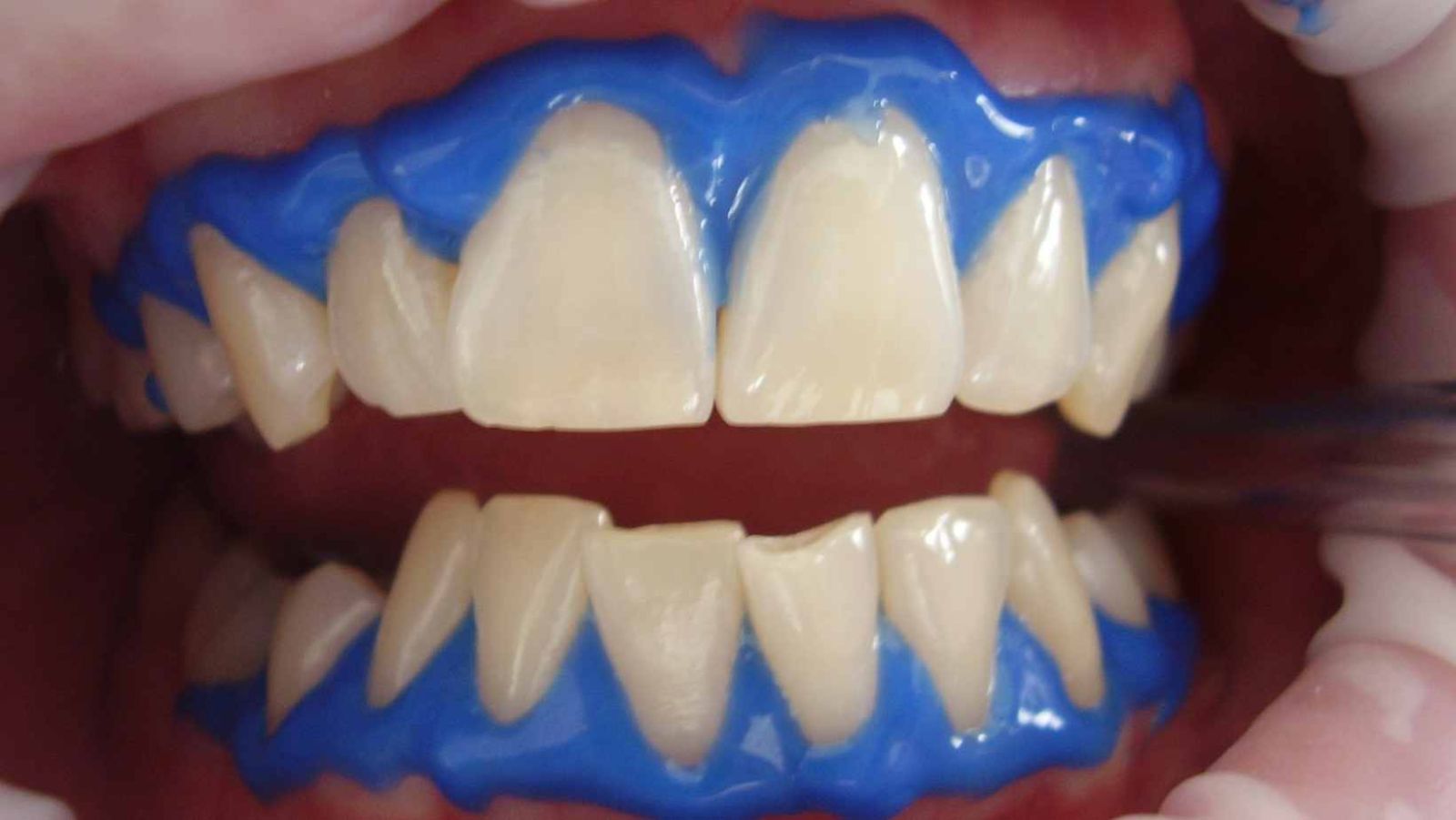 Kits de blanchiment dentaire : attention danger pour votre sourire !