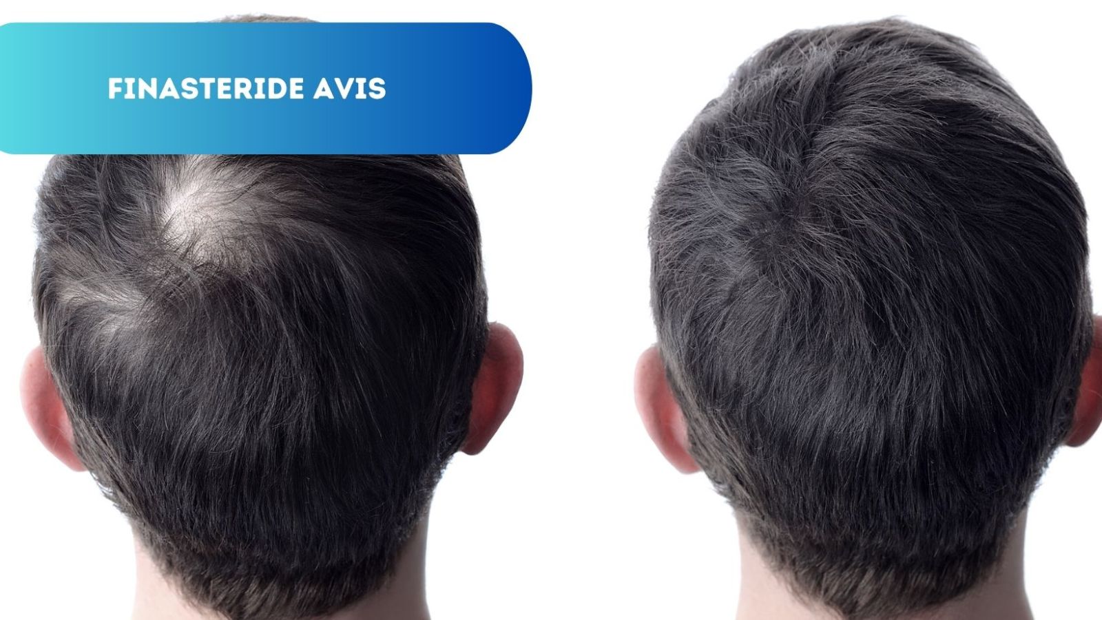 Avis Finastéride: Solution Efficace contre la Chute de Cheveux?