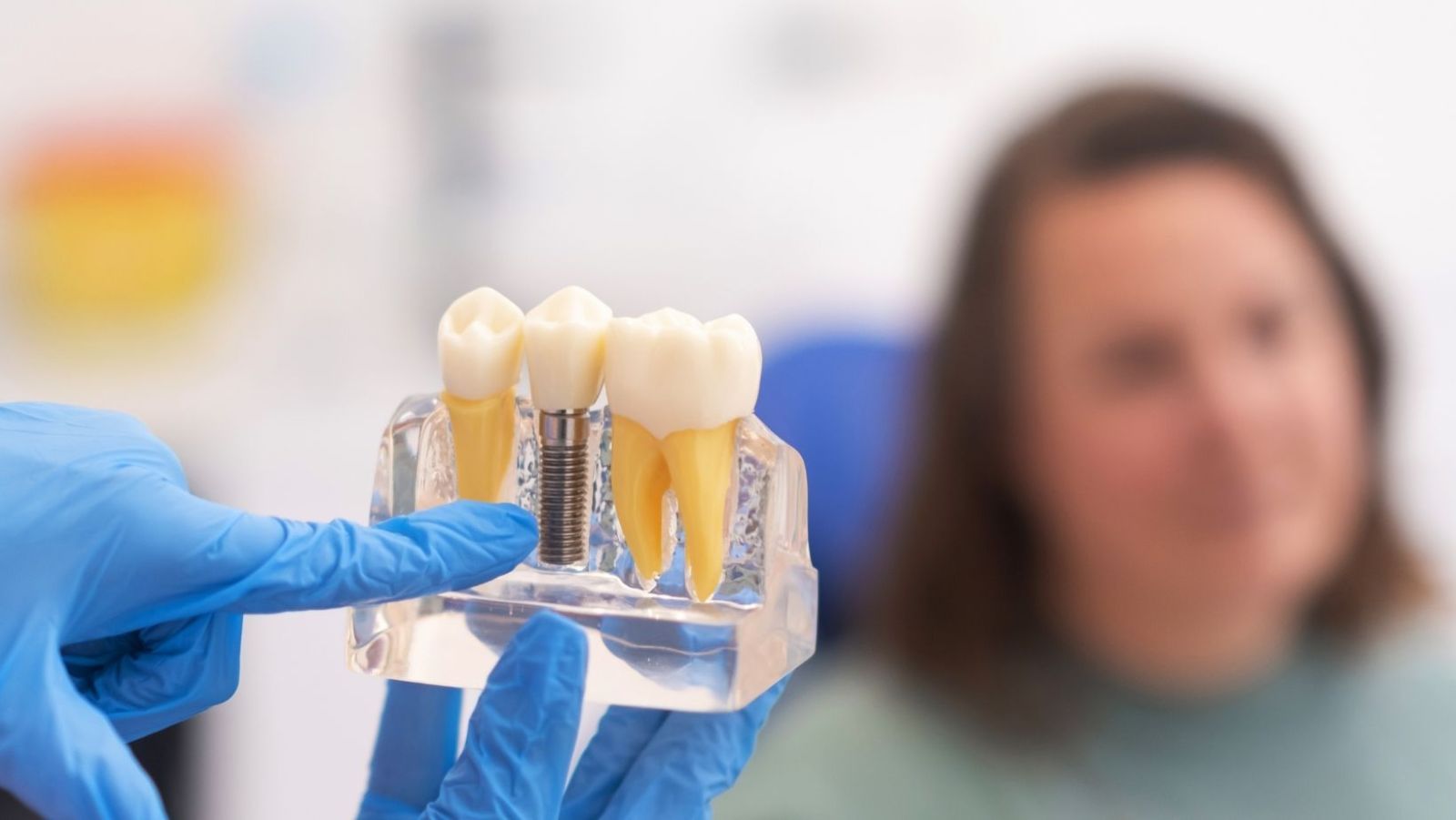 Implants dentaires : découvrez le nombre maximal qu'on peut poser en une séance